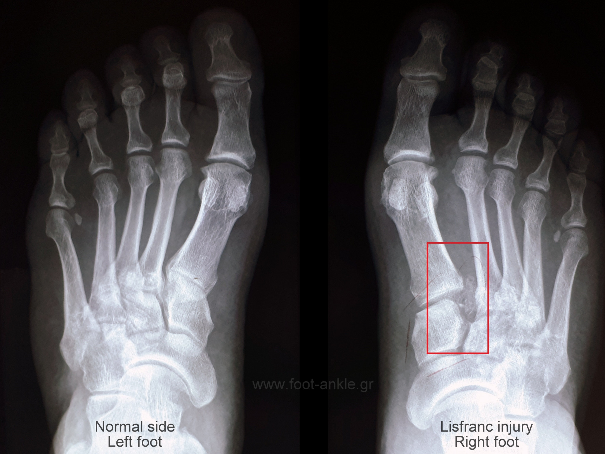 Lisfranc injury. Comparative weight bearing radiographs XRays showing a Lisfranc injury of the right foot (red box)