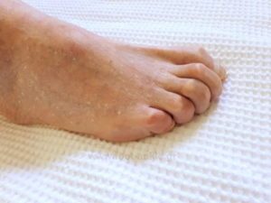 Clinical image of a right foot with a claw toe deformity of all the lesser toes